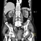 Hypertrophy of bladder wall, urinary bladder, hydronephrosis, CT cystography: CT - Computed tomography